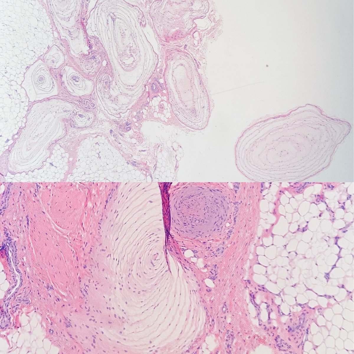 liannagoetz_MD's tweet photo. Here’s an #iphone pic of a Pacinian party 🎉🎊 #paciniancorpuscle #pacinianparty #digitalpathology #iphonemicroscopy #nopressure #goodvibrations 😉 https://t.co/wzjHTHn0QQ