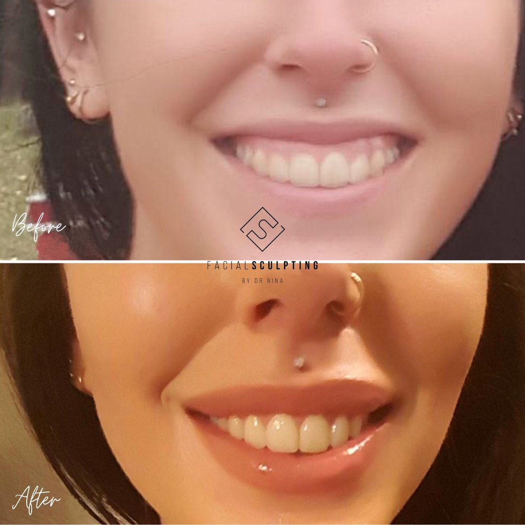 DrNinaBal's tweet photo. Say "cheeeese"!
This is a treatment that I simply love because it combines my two biggest passions: smiles and beauty. 
Find out all about it in my latest IG post! https://t.co/0aCpCqGVmg
