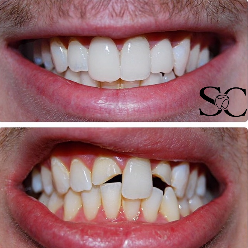 SimplyCrowns's tweet photo. Ready for the glow up your teeth deserve? We got you covered! 

Visit https://t.co/A2BiifPt4a for more info!

#transformationtuesday #tuesdaymotivation #smile #dentistry #dentist #dentalcare #teeth #teethwhitening #healthy #teethcleaning #health #dentalcare #ATX #Austin #Texas https://t.co/jexUTmWk9G