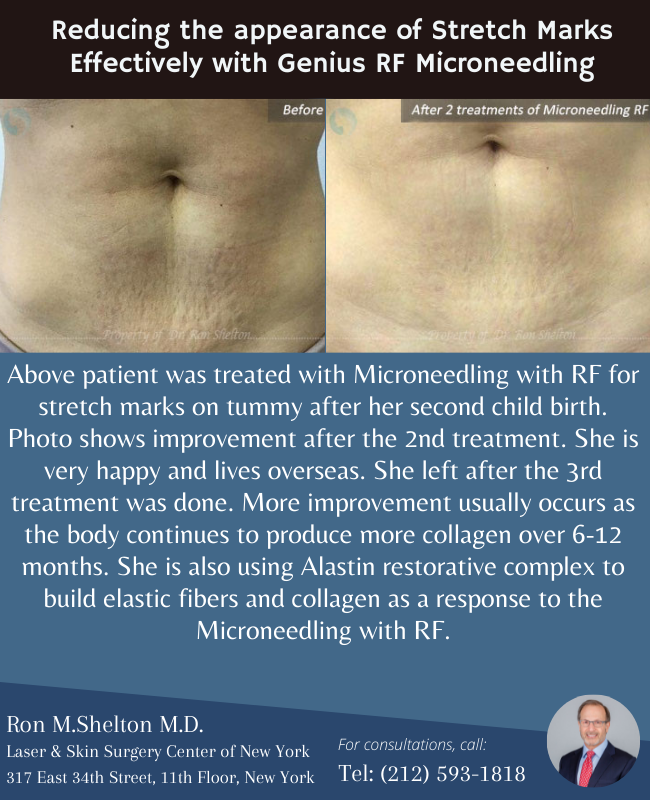 drronsheltonmd's tweet photo. Below patient was treated with Microneedling with RF for stretch marks on tummy after her second child birth.
View more before / after photos at : https://t.co/IurazLva1A
#genius #microneedling #microneedlingrf #stretchmarkremoval #stretchmarksolution #stretchmarkstreatment https://t.co/Bp1V7eSoue