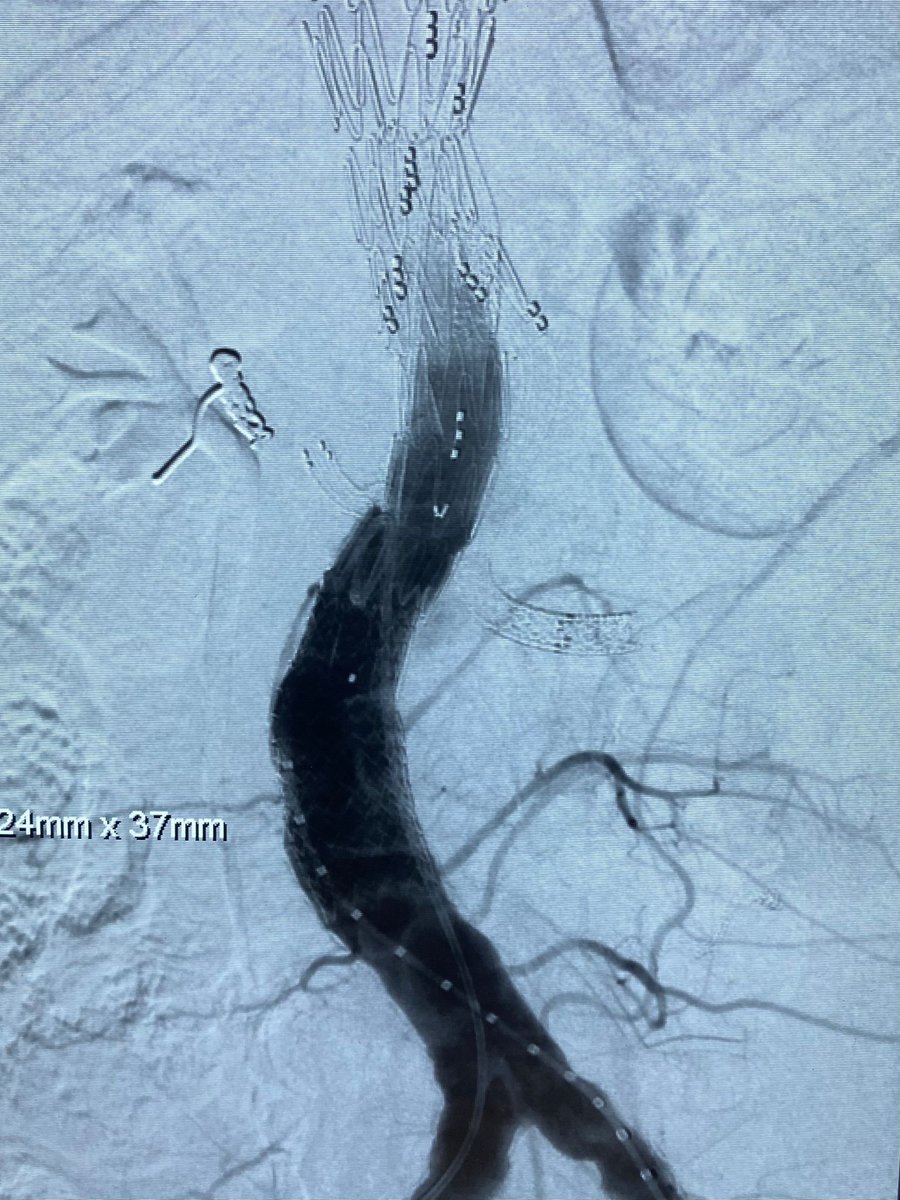 Imaging MFT (@mft_imaging) on Twitter photo The team at work earlier today doing an emergency 4 vessel branched repair of a rapidly expanding thoracoabdominal aneurysm, secondary to dissection. After 7 hours, thanks to everyone! <a href="/NirmalKakani/">Nirmal Kakani</a> <a href="/ukradiologist/">Anantha Krishnan</a> @Mancvascular <a href="/Manchester_IR/">@manchester_IR</a> <a href="/SCoRMembers/">SCoR Members</a> <a href="/BSIR_News/">The British Society of Interventional Radiology</a> #wrd2021 The team at work earlier today doing an emergency 4 vessel branched repair of a rapidly expanding thoracoabdominal aneurysm, secondary to dissection. After 7 hours, thanks to everyone! <a href="/NirmalKakani/">Nirmal Kakani</a> <a href="/ukradiologist/">Anantha Krishnan</a> @Mancvascular <a href="/Manchester_IR/">@manchester_IR</a> <a href="/SCoRMembers/">SCoR Members</a> <a href="/BSIR_News/">The British Society of Interventional Radiology</a> #wrd2021