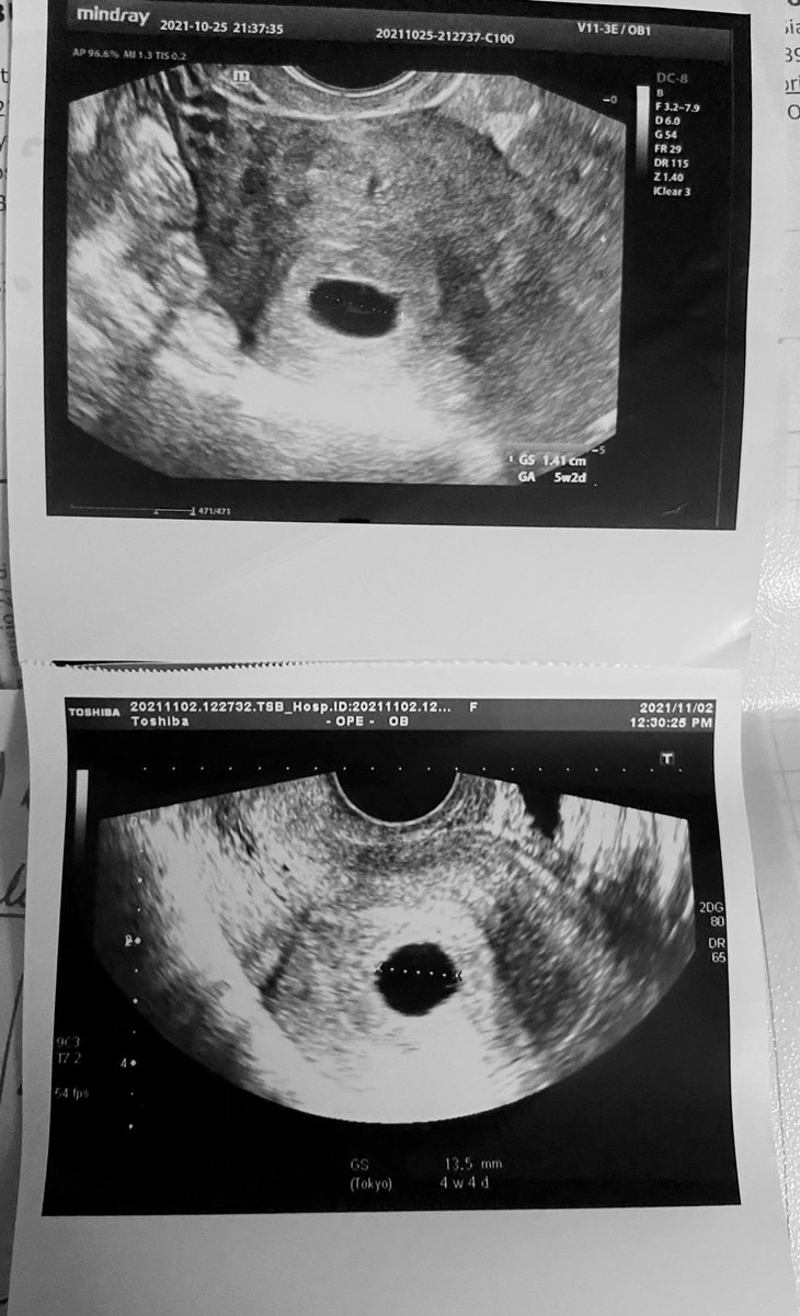 Wannabeamama's tweet photo. Top was my 9th week scan. Bottom is from today; normally, it wouldโve been 10th week. With normal pregnancies, at 10th week youโd easily hear a heartbeat or see the form of baby. With mine though.. there is just nothing in there. #blightedovum https://t.co/RoXvGNnCyF