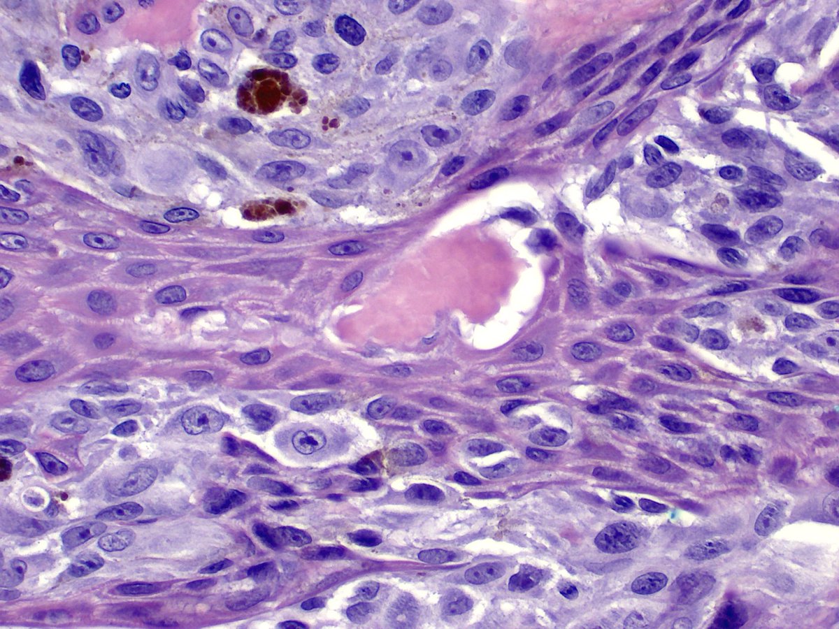 I don't understand why these eosinophilic blobs, named after Hideko Kamino, should be such a useful finding.  But even in the age of fusions, aCGH and NGS they still hold up very well!  Some musings from 20 years ago... pubmed.ncbi.nlm.nih.gov/11481532/
#dermpath #pathology #dermatology