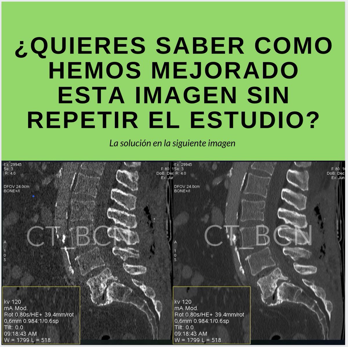 danyfcarame's tweet photo. Fíjate en estas dos imagenes y en todos sus parámetros.
Si sabes cómo hemos mejorado esta imagen sin repetir el estudio coméntalo.
La solución:
https://t.co/KQj1qWlM06
#rad #ctscan #xray #radiology #radiographer #radtech #foamed #foamrad #xraystudent #education @ACTEDI https://t.co/xvso93xkwN