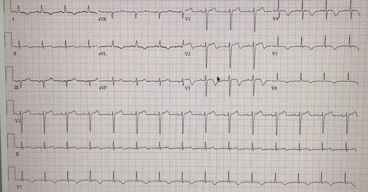 Vivek Kulkarni MD (@vivekkulkarnimd) on Twitter photo This classic #ecg that came up as a routine pre-op ECG! Wellens ST/T changes, suggesting LAD-territory ischemia. LHC confirmed severe obstructive disease. A great reminder to always keep your eyes (& brain) open when on consults! #cardioed #meded #ACCFIT <a href="/CooperCVFellows/">Cooper Cardiology Fellows</a> This classic #ecg that came up as a routine pre-op ECG! Wellens ST/T changes, suggesting LAD-territory ischemia. LHC confirmed severe obstructive disease. A great reminder to always keep your eyes (& brain) open when on consults! #cardioed #meded #ACCFIT <a href="/CooperCVFellows/">Cooper Cardiology Fellows</a>