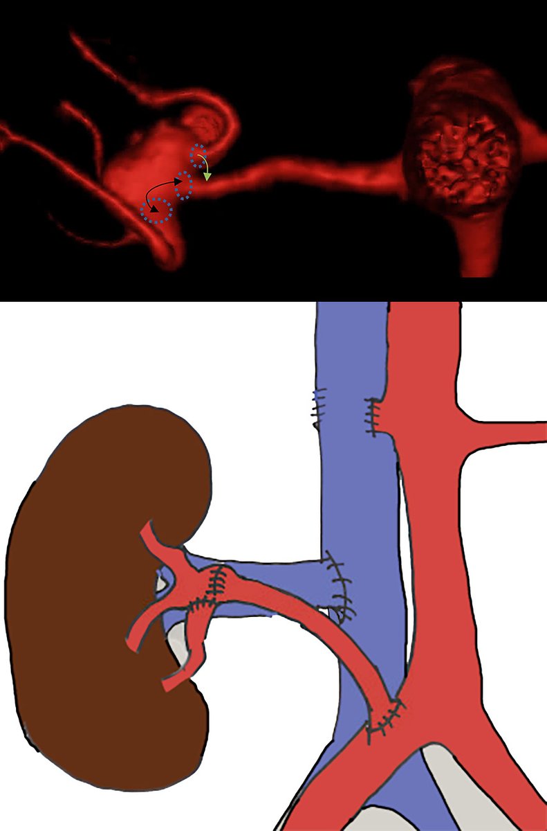 MelSharafuddin's tweet photo. Complex hilar renal artery aneurysm reconstruction necessitating auto-transplantation. Never thought I'd have to do one🤫 #VascTwitter #Teamwork #DanielKatz @UIowa_Surgery https://t.co/ATBfHxcshP
