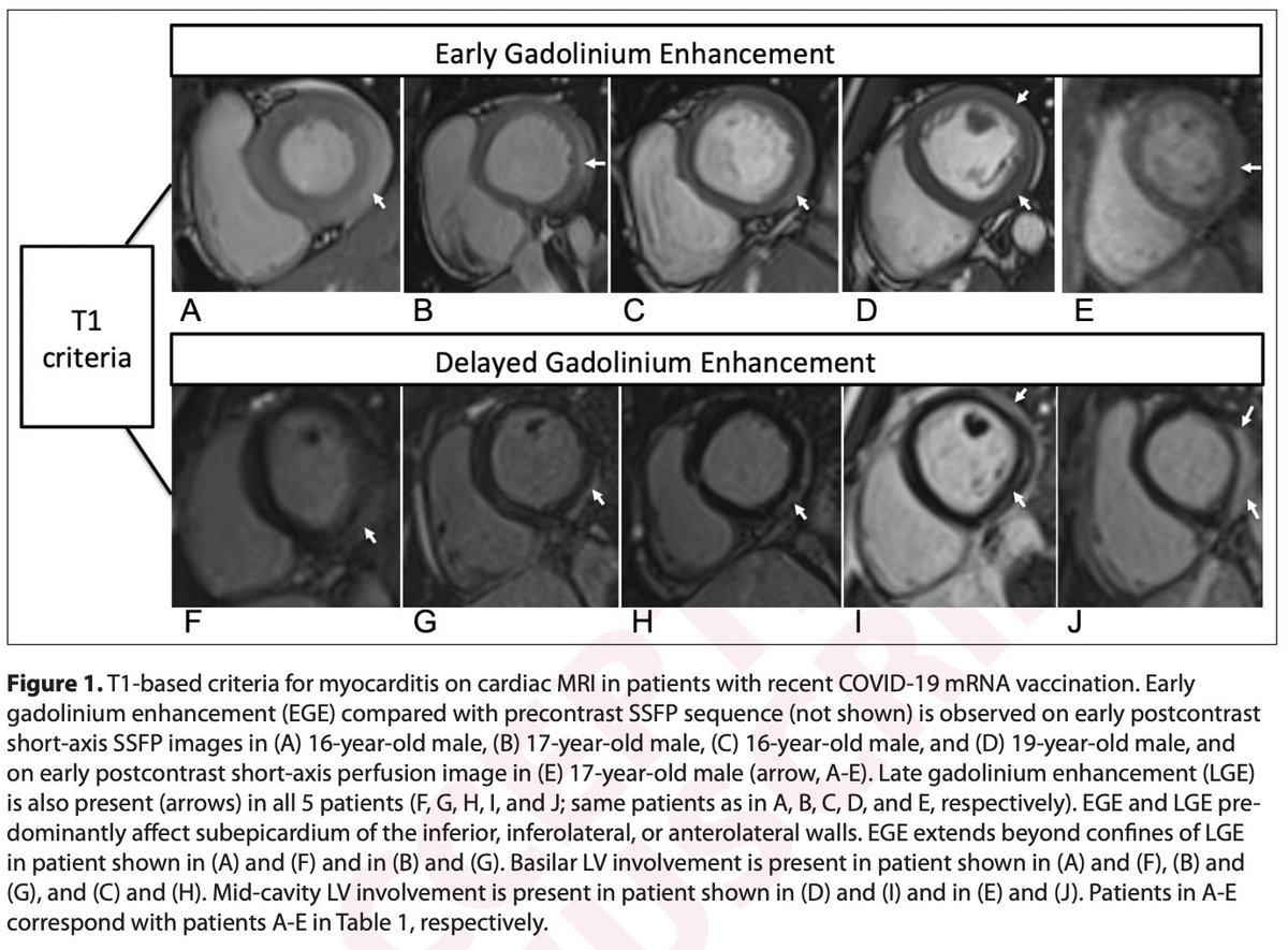 epidatum's tweet photo. Cardiac MRI Findings of #Myocarditis After #COVID19 #mRNA #Vaccination in Adolescents

5 patients, all males with age ranging from 16 to 19 years presented within 4 days of the second dose of #COVID19 #mRNA #vaccine without known prior #COVID-19 
https://t.co/1RafW8Su70 https://t.co/0bkZpJ4lDo