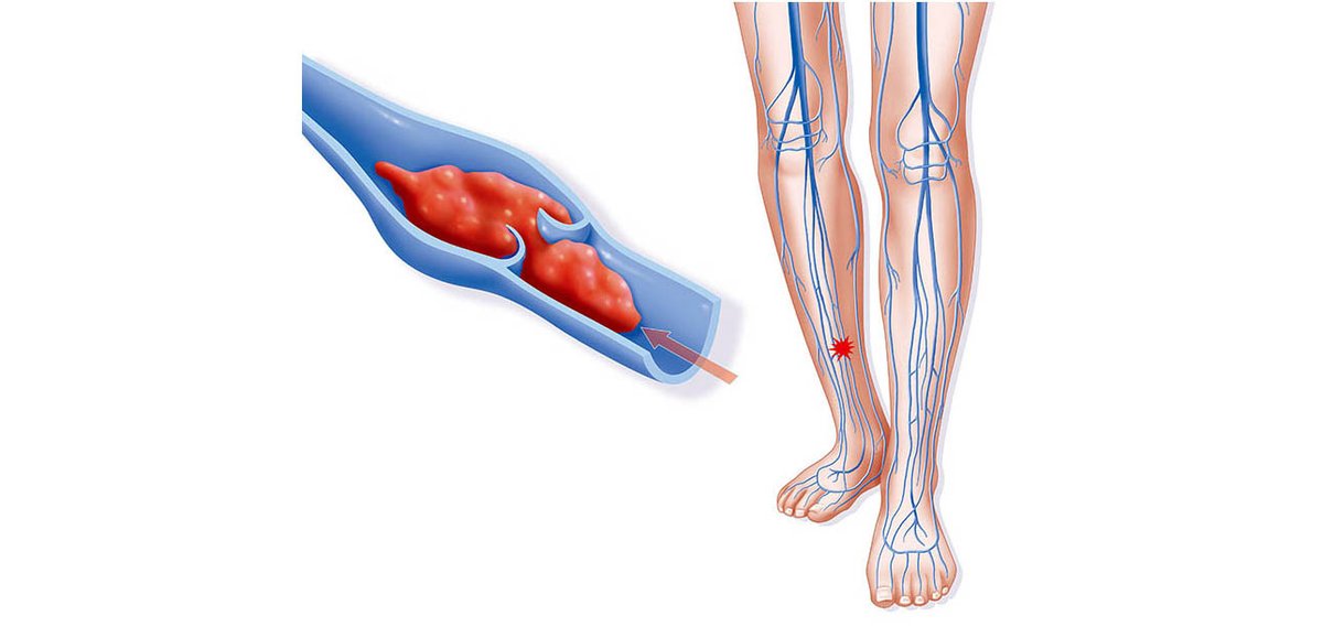 Medscape's tweet photo. A European study has found an elevated risk of venous thromboembolism in COVID-19 patients who were not critically ill.
https://t.co/eq9yqEdTNw https://t.co/O3O2CAt5az