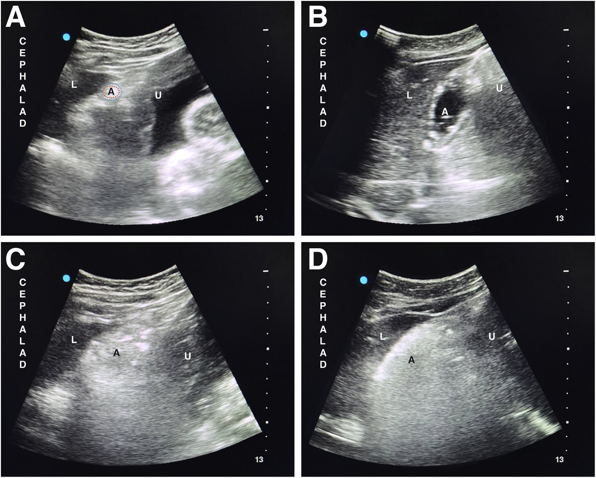 BJAJournals's tweet photo. 'With the inherent risks of aspiration in pregnancy, #POCUS can be used to understand the type of content and the volume of liquid content in the patient who may require airway interventions'

Read our #BJAEducation Essential Notes for details...

https://t.co/GzKlThTX5D https://t.co/0bnOhMrBDi