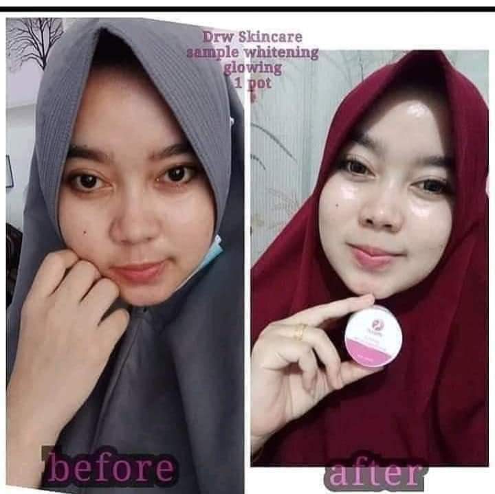 EfiHumayra's tweet photo. KALAU MIKIR MAHALNYA, BERAPA PUN GAK AKAN KEBELI.. 
TAPI, KALAU MIKIRNYA MAU SEHAT, BERSIH, CANTIK BERAPAPUN AKAN DIBAYAR 😙😚

☑ Dapat cantik dan sehatnya

KONSULTASI DOKTER GRATIS 

#DrwSkincareIndonesia https://t.co/Cos1zTU0gs