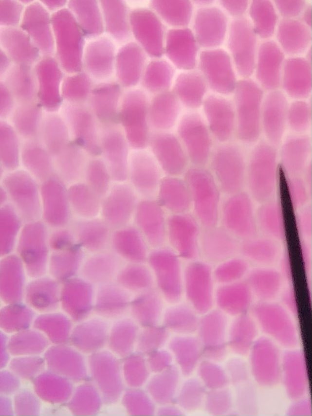 STMsrichards's tweet image. Onion cell osmosis!!!   The students were fascinated with this lab !  Cells shrink in hypertonic solutions but swell in hypotonic solutions.  It was a hit!!   #microscopelab #osmosis #ilovebiology @stmsaints