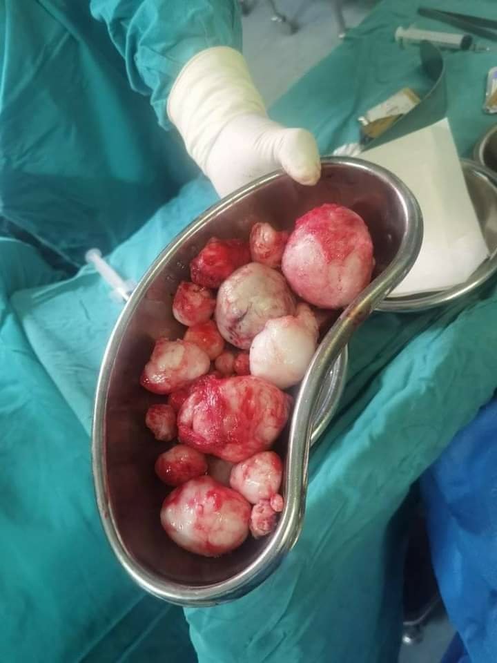 These are fibroids, from a 31 year old female patient who has had miscarriages and experienced painful menstrual cycles.

My point is people go through a lot,and it is not your place to ask questions like.

-"When are you having kids."