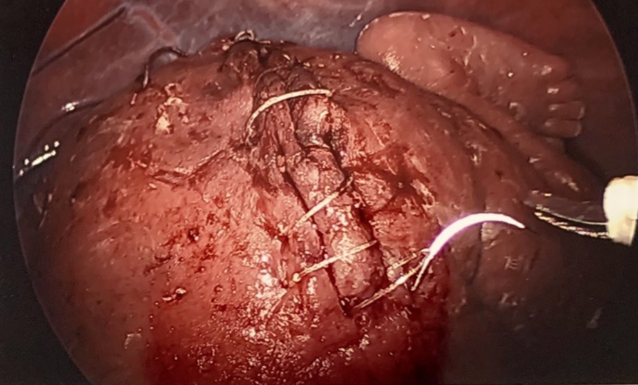 ramen_chmait's tweet photo. Fetoscopic repair of open spina bifida. Final touches of suture closure of the skin on the back. #fetalsurgery 
(shown with permission) https://t.co/vaA9faB3uQ