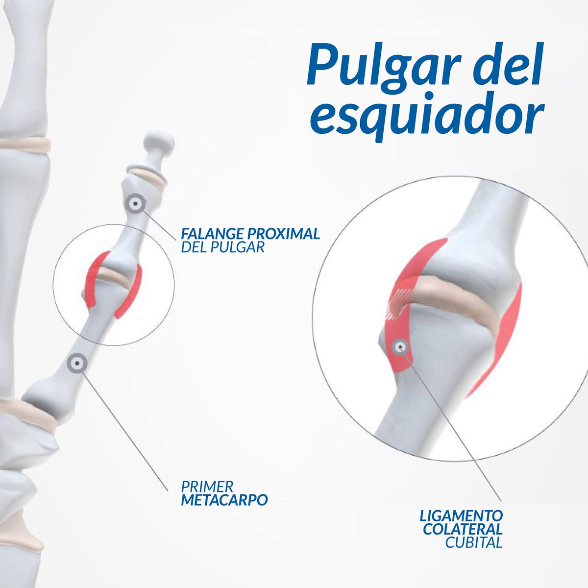 lopezcorcuera's tweet photo. Esta lesión conocida así por su frecuencia al practicar este deporte, se produce por la rotura del ligamento de la base del pulgar, impidiendo la apertura normal del dedo. La rotura puede ser total, necesitando cirugía, o parcial, pudiendo ser recuperada con fisioterapia. https://t.co/4BtlVHvUsc