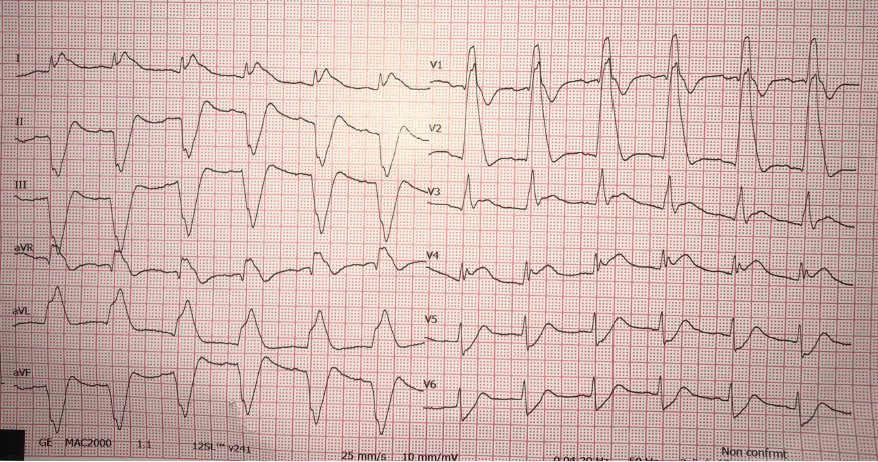 Francesco Vitali (@fra_vitali90) on Twitter photo CA just outside emergency department entrance:
➡️ VF ➡️ ⚡️⚡️⚡️ ➡️ EKG ➡️ 😱😱 ➡️ cath lab
#ECG #CardioTwitter #MedTwitter #FOAMed <a href="/smithECGBlog/">Stephen W. Smith</a> CA just outside emergency department entrance:
➡️ VF ➡️ ⚡️⚡️⚡️ ➡️ EKG ➡️ 😱😱 ➡️ cath lab
#ECG #CardioTwitter #MedTwitter #FOAMed <a href="/smithECGBlog/">Stephen W. Smith</a>