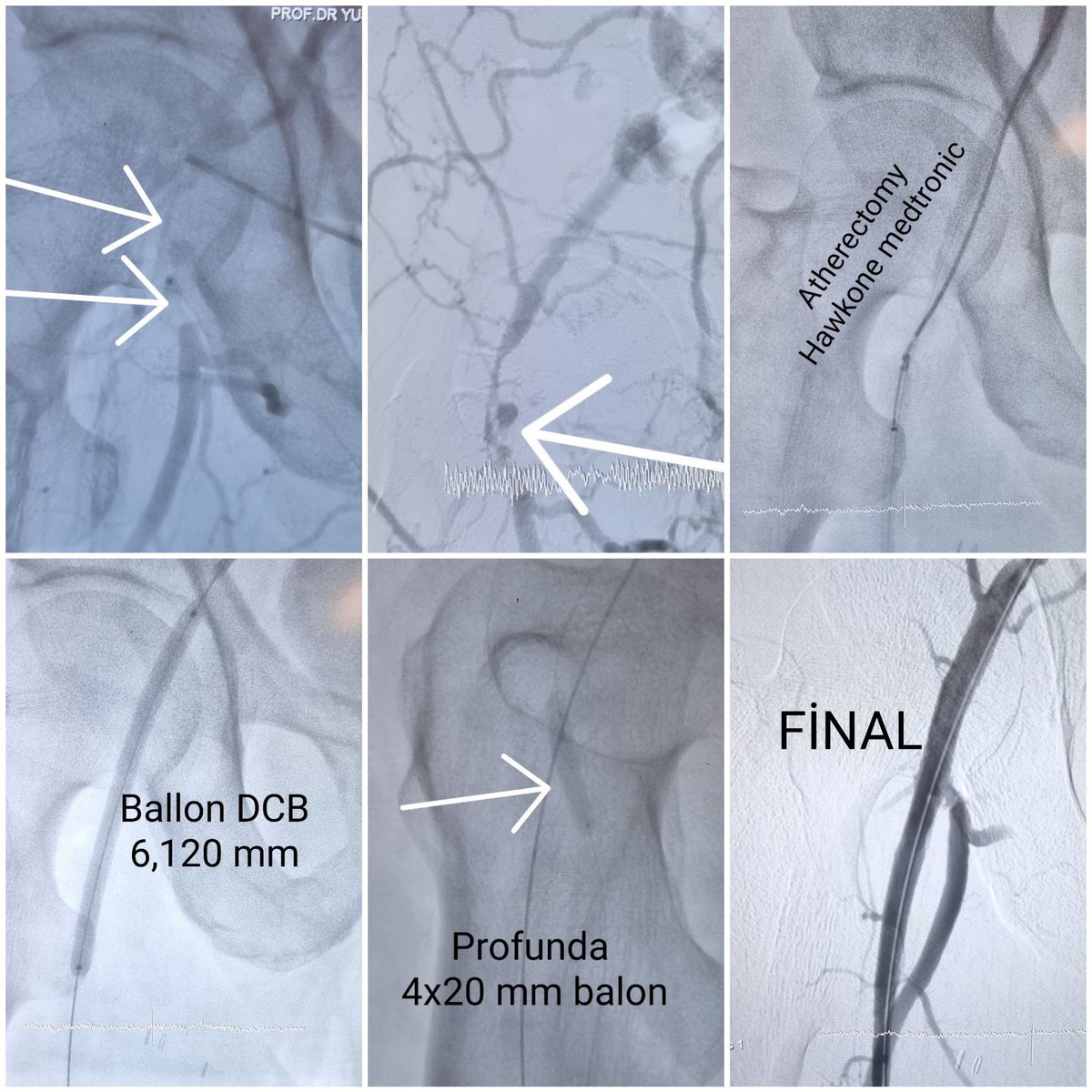 dryusufkaraveli's tweet photo. CFA,SFA bifurcation 100%, RTH 3, atherectomy and DCB. Atherectomy will be the right choice for localizations where we are afraid of stent implantation. #atherectomy #hawkone #peripheral @Kardiyoloji_ @gokseldagasan https://t.co/Dvbav7qjg4