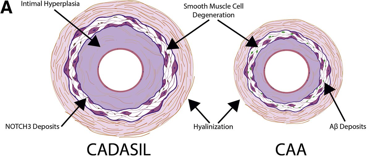 Overlapping Protein Accumulation Profiles of CADASIL and CAA: Is There a Common Mechanism Driving Cerebral Small-Vessel Disease? FREE Review in this month's Small Blood Vessel Disease in the Brain Theme Issue. From <a href="/UMich/">University of Michigan</a> and <a href="/VAAnnArbor/">VA Ann Arbor</a>. ajp.amjpathol.org/article/S0002-… #neuropathology