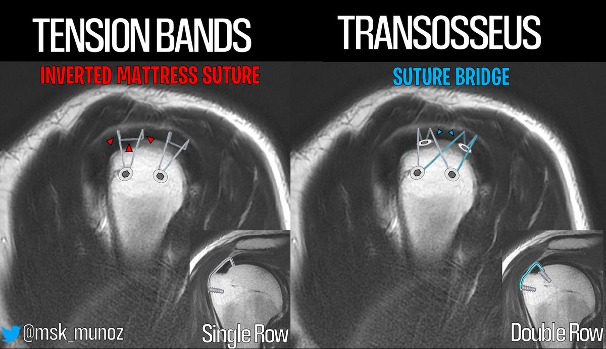 ROTATOR CUFF REPAIR:

1- TENSION BANDS - single row
2- TRANSOSSEUS EQUIVALENT (suture bridge) - double row

#mskradiology #orthotwitter #radiology #shoulder #medtwitter