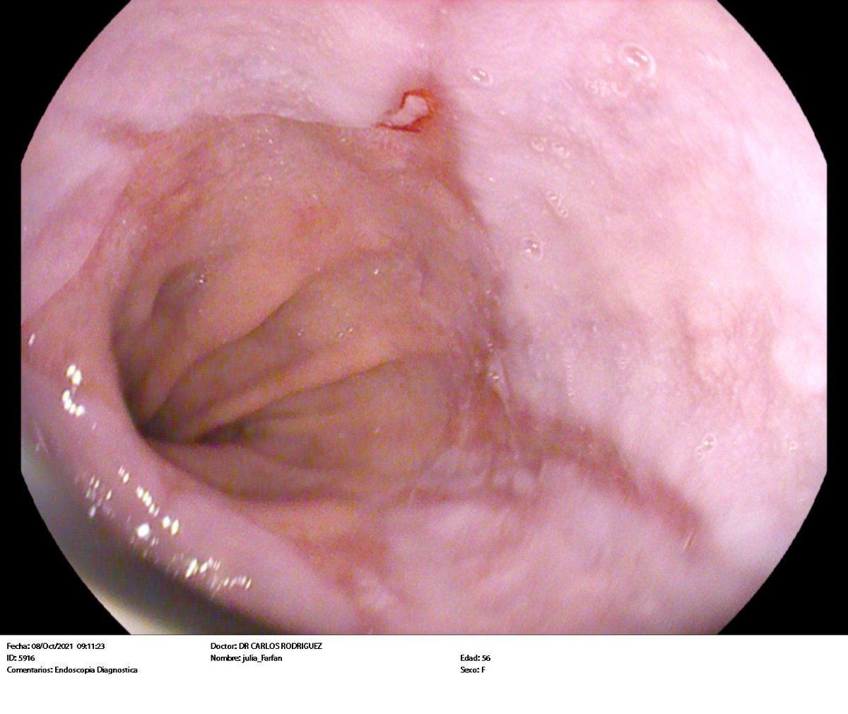 drenriquearias's tweet photo. #Esofagitis por reflujo gastroesofágico, sino se diagnostica y trata adecuadamente puede causar una lesión precancerosa llamada #EsofagoDeBarret.
Si tiene pirosis (acidez en tórax) sensación de regurgitación, consulte con un especialista, no se automedique https://t.co/5jE9zp2vpv