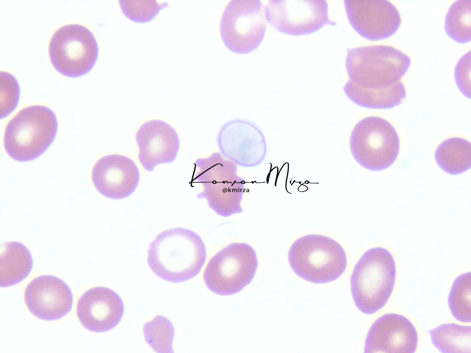 KMirza's tweet photo. #HemeDaily #hemepath #leusm

Trainees! What's going on here? How does this finding happen, and what does it mean?

#blood #bloodsmear #pathology #path2path #pathmatch22 https://t.co/UZPtJ5n5p6