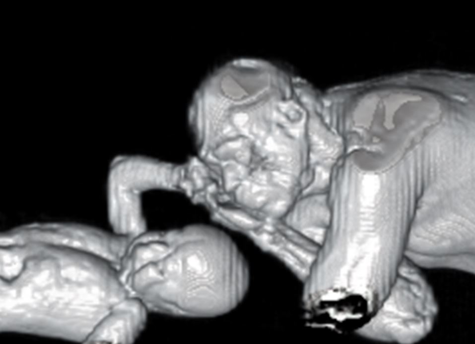 "Child-Parent Combo" is a novel MRI approach for imaging young children without GA or sedation. Our new   paper in EJR <a href="/SafwatAly5/">Safwat Aly</a> and <a href="/larsgrowo/">Lars Grosse-Wortmann</a>