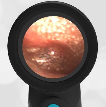 WiscMedWispr's tweet photo. Shagrination or “Cobble Stoning” https://t.co/eiM5RHfNF5 #ACEP #icliniq #Peds #Otoscopy #DigitalOtoscope #Wispr @WiscMedWispr https://t.co/bROfWl3bGD