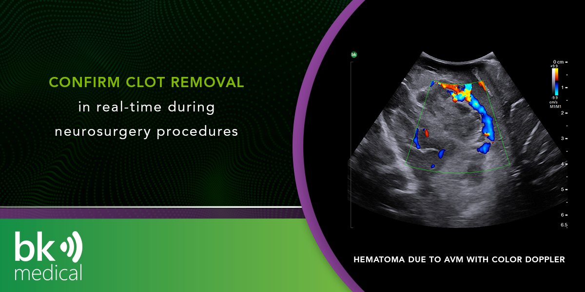 Whether you are localizing a hematoma or advancing a catheter, use active imaging with #IntraoperativeUltrasound to assess and confirm clot removal in real-time. Learn more here: hubs.la/H0-8MZW0 #activereassurance