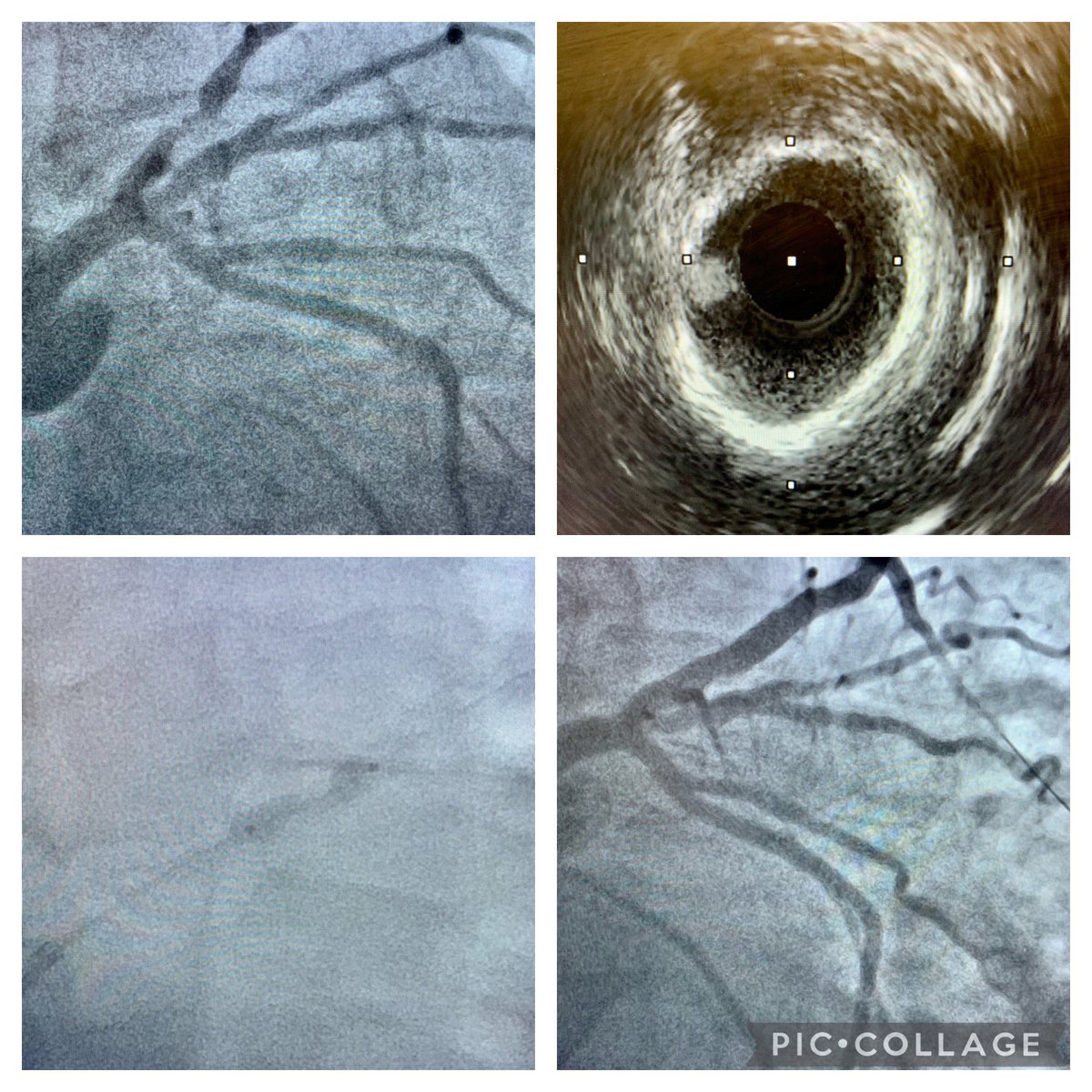 ReVascMed (@revascmed) on Twitter photo Successful <a href="/ShockwaveIVL/">Shockwave Medical</a> therapy for concentric #calcium in resistant Prox LAD lesion with excellent result. #PennsyInterventions <a href="/jcgeorgemd/">Jon George</a> <a href="/GPAngioClub/">Phila Angio Club</a> <a href="/ACVCPhila/">Academy for CardioVascular Collaboration</a> <a href="/PennCVFellows/">Penn Cardiology Fellows</a> Successful <a href="/ShockwaveIVL/">Shockwave Medical</a> therapy for concentric #calcium in resistant Prox LAD lesion with excellent result. #PennsyInterventions <a href="/jcgeorgemd/">Jon George</a> <a href="/GPAngioClub/">Phila Angio Club</a> <a href="/ACVCPhila/">Academy for CardioVascular Collaboration</a> <a href="/PennCVFellows/">Penn Cardiology Fellows</a>
