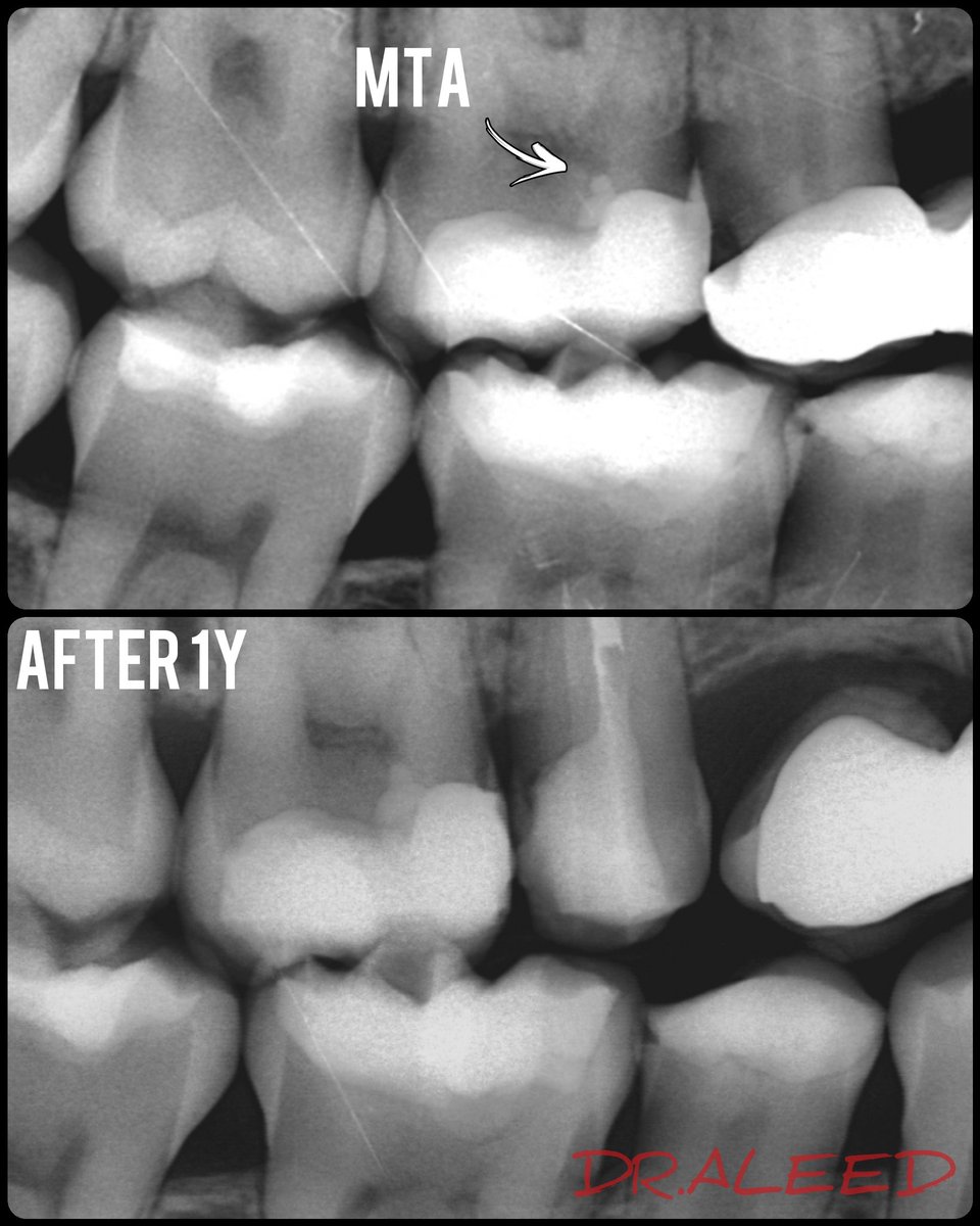 To be a good endodontist you should know how to save the pulp not only remove it .
Direct pulp capping with 1 year follow up