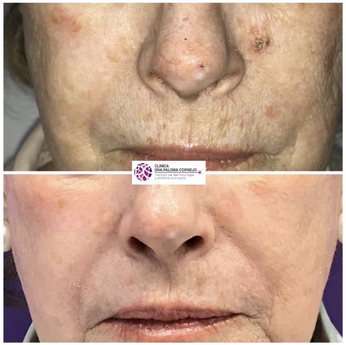 DoctoraLaser's tweet photo. Las queratosis actínicas son lesiones #precancerosas debidas al #fotoenvejecimiento q pueden desembocar en un #carcinoma #espinocelular 

Post completo👉🏻 https://t.co/D2qIuShzKu

#doctoraláser #dermatologomadrid  #dermatologíamadrid  #lasermadrid 
#queratosisactínicas #queratosis https://t.co/D0VKsDdrFC