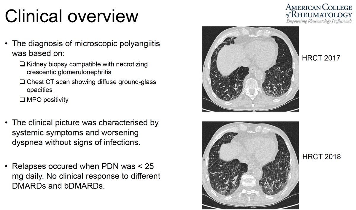 ERheumat's tweet photo. VEXAS in ANCA
π€Is the ANCA positivity an Epiphenomenon
π€how do you manage AAV+VEXAS
π€With reports of vexas in non RP ARDs should we consider ARD+VEXAS overlap ?? eg AAV+Vexas Overlap
#ACR2021 #ACRGlobal https://t.co/An0i4NYuTB