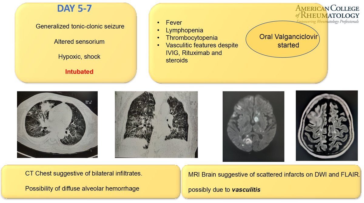 ERheumat's tweet photo. Interesting case AAV:
CMV is a perpetual enemy of any rheumatologist
have a low threshold of suspicion
pre-immunosuppression screening has plausibility issues in real world
IVIG could be a lifesaver in infection vs inflammation conundrum
@SujataGanguly17 #ACR2021 #ACRGlobal https://t.co/sImmLeld5u