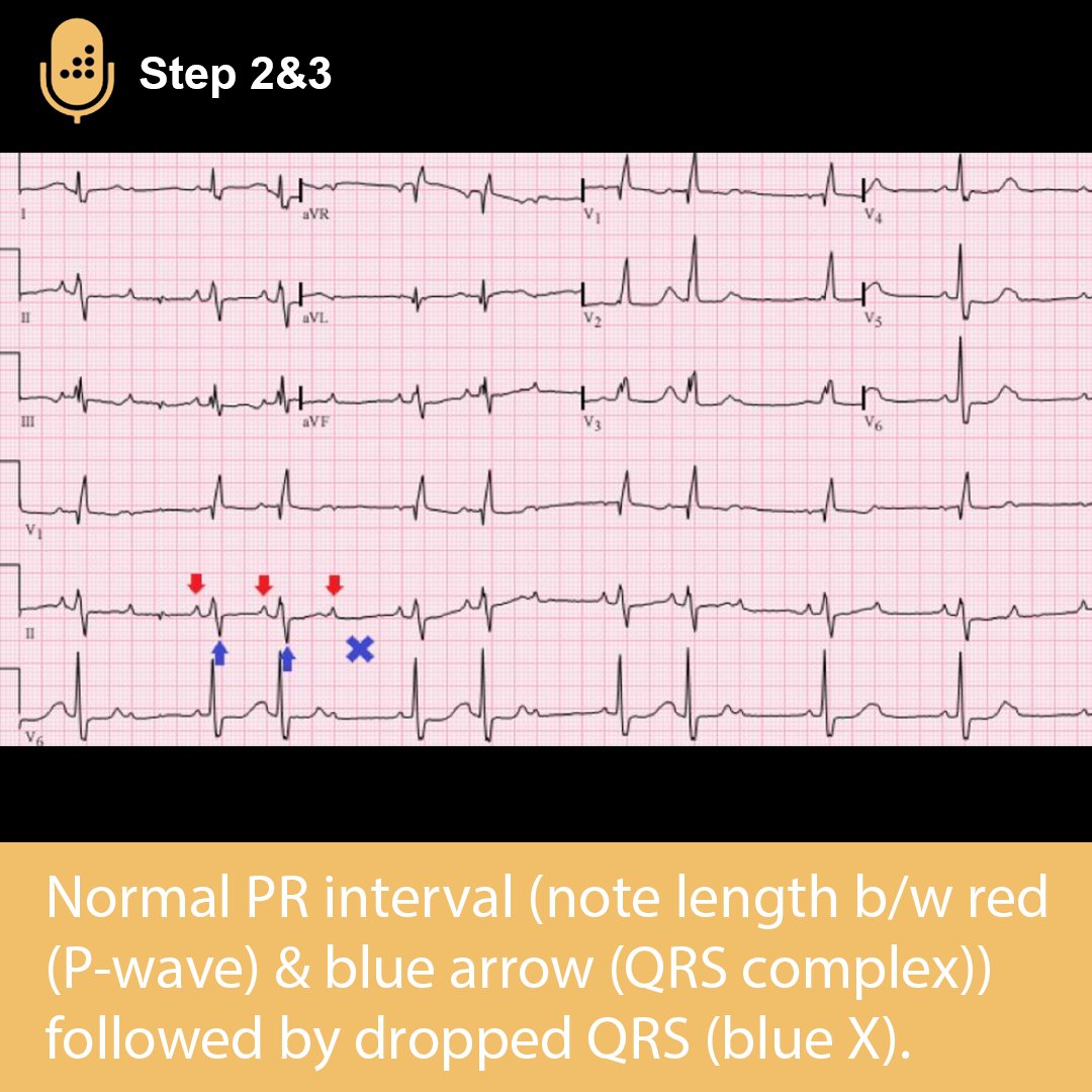 medbullets's tweet photo. Second degree heart block type II presents with a normal P-R interval followed by a dropped QRS complex.

Learn more about Atrioventricular (AV) Heart Block on our DAILY #USMLE Step 2 &amp; 3 podcast. #medschool #medstudenttwitter #medtwitter https://t.co/XOHUsKwlNx https://t.co/BvHOUBDCcJ
