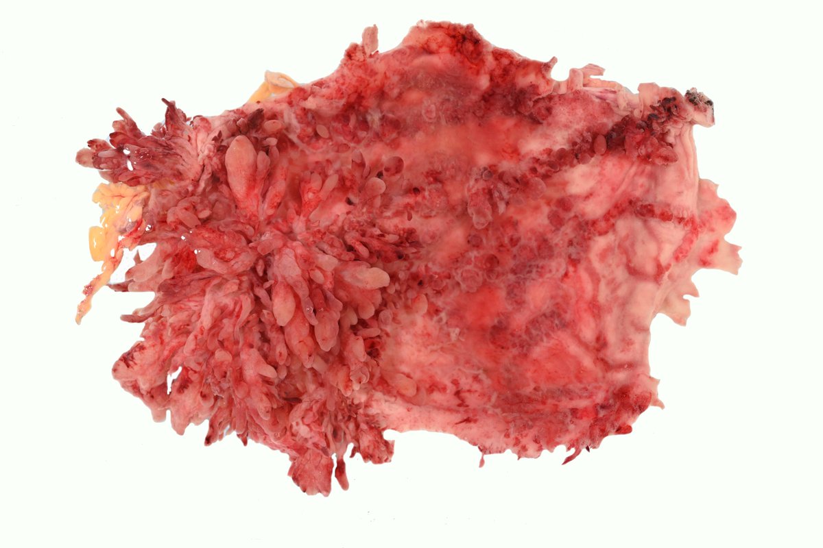LizMontgomeryMD's tweet image. This spectacular gross image is of a gastrectomy from a patient with juvenile polyposis.   The patient may have a SMAD4/DPC4 germline mutation since the latter is associated with gastric juvenile polyposis.  Dr. Aatur Singhi provided the image (I just photoshopped it).