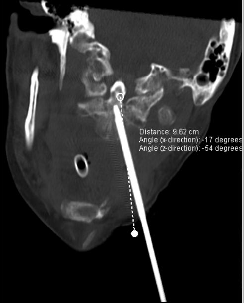 Percutaneous CT guided Odontoid Biopsy <a href="/SIR_ECS/">SIR ECS</a> <a href="/SIRRFS/">SIR RFS</a>