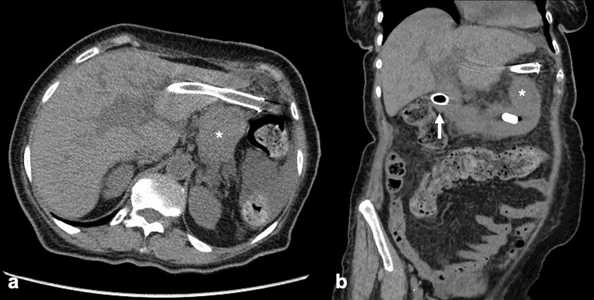 bardiamoosavi's tweet photo. Check out our paper describing a salvage technique for retrieval of a migrated hepatogastrostomy stent! @ABessissow @mcgillradiology @CAIRweb @CVIR_Journal @cirsesociety @SIRspecialists @SIR_ECS #IRad #MedTwitter  https://t.co/1AC2Ey1YG0 https://t.co/scbYnGwqWf