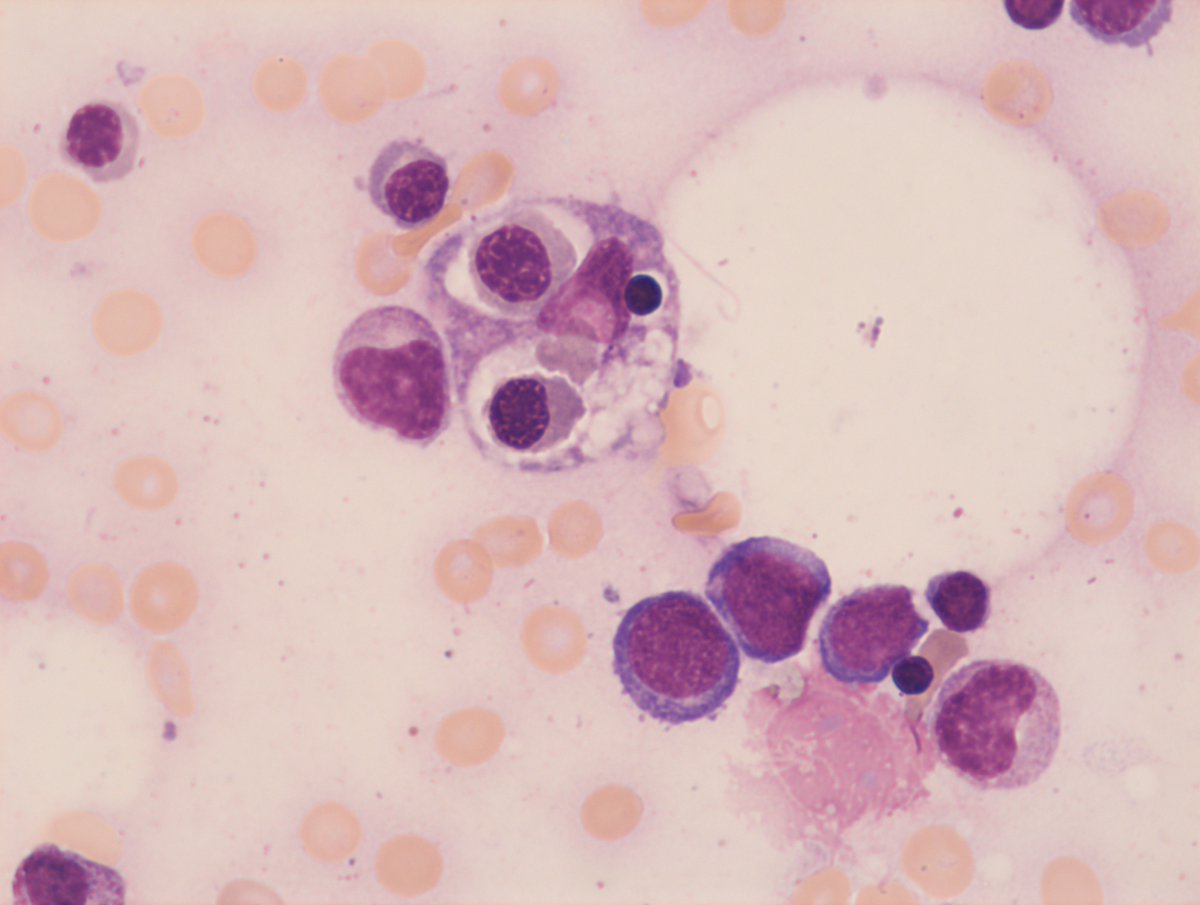 #morningcytologyrounds at Marien Hospital #88
A lady with WBC 350/µL, Hgb 7.2 g/dL and PLT 11.000/µL was admitted for diagnosis. LDH 1298 U/L, INR 1.5, PTT 49 sec., Fibrinogen 100 mg/dL. Ferritin 90.000 ng/mL. She is severely ill. Bone marrow cytology reveals hemophagocytosis /1.