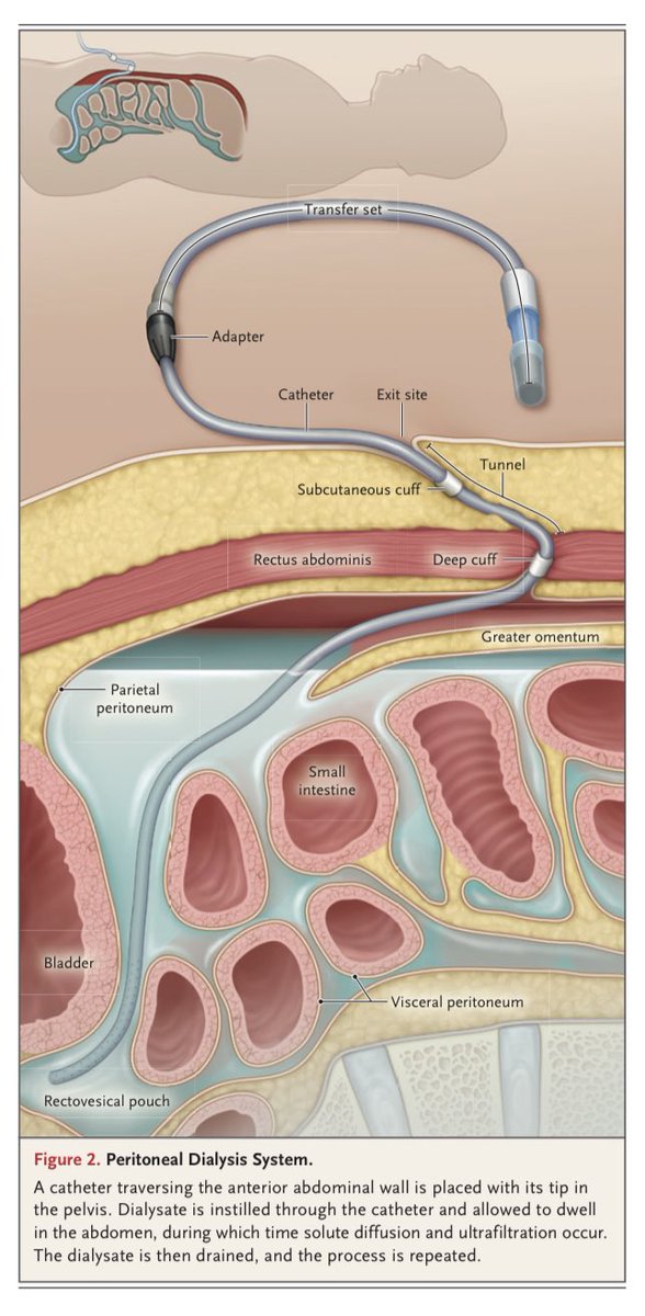 Diálisis Peritoneal  

Revisión del NEJM
Doi: 10.1056/NEJMra2100152