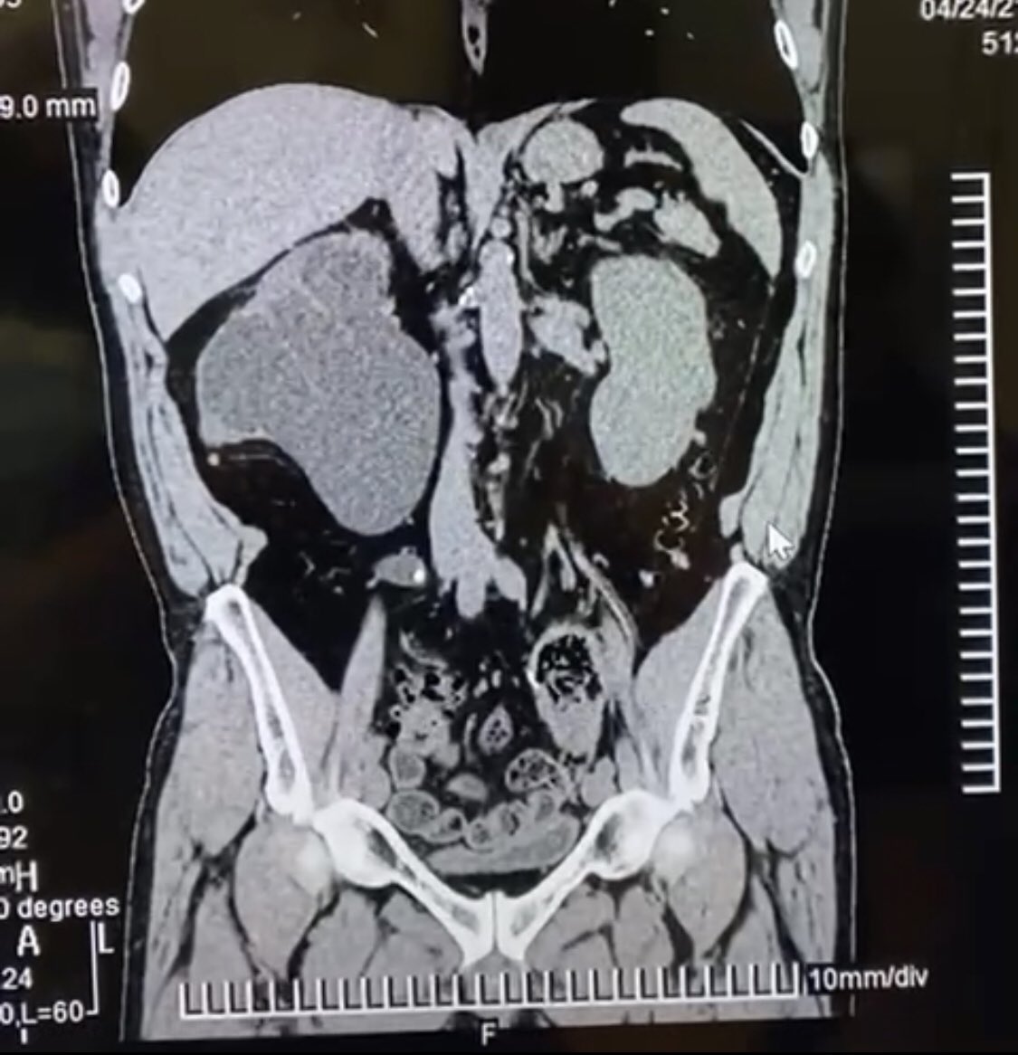 umaemac's tweet photo. Nefrectomía simple derecha laparoscópica en paciente masculino de 60 años de edad con exclusión renal derecha secundario a litiasis de uréter ipsilateral. @urovictore @JRBR83 @Rocktor_Uro @Alejandro_Agc #Laparoscopicsurgery #UroSoMe https://t.co/Ehk5GyGe3K