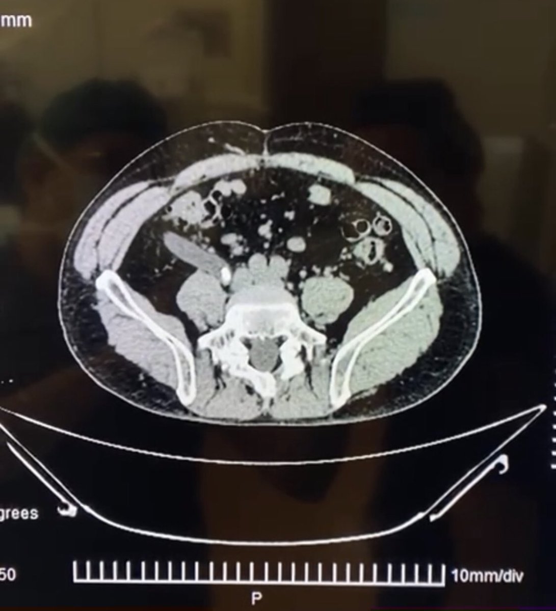 umaemac's tweet photo. Nefrectomía simple derecha laparoscópica en paciente masculino de 60 años de edad con exclusión renal derecha secundario a litiasis de uréter ipsilateral. @urovictore @JRBR83 @Rocktor_Uro @Alejandro_Agc #Laparoscopicsurgery #UroSoMe https://t.co/Ehk5GyGe3K