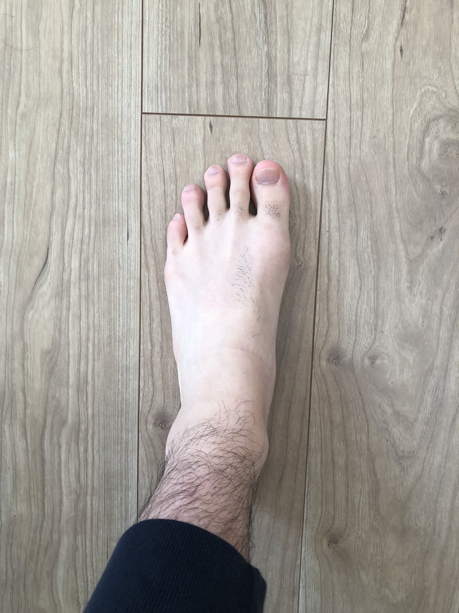 メンズ脱毛ライフ 足の甲 照射レベル6 4回目 レベル8 1回目 コメント これがレベル8か 脱毛 脱毛器 ケノン ケノンレポ ケノン脱毛器 ケノン効果 メンズ脱毛 メンズ 全身脱毛 セルフ脱毛 足 足指 足の甲 指毛 指 T Co Szo9bdbydm