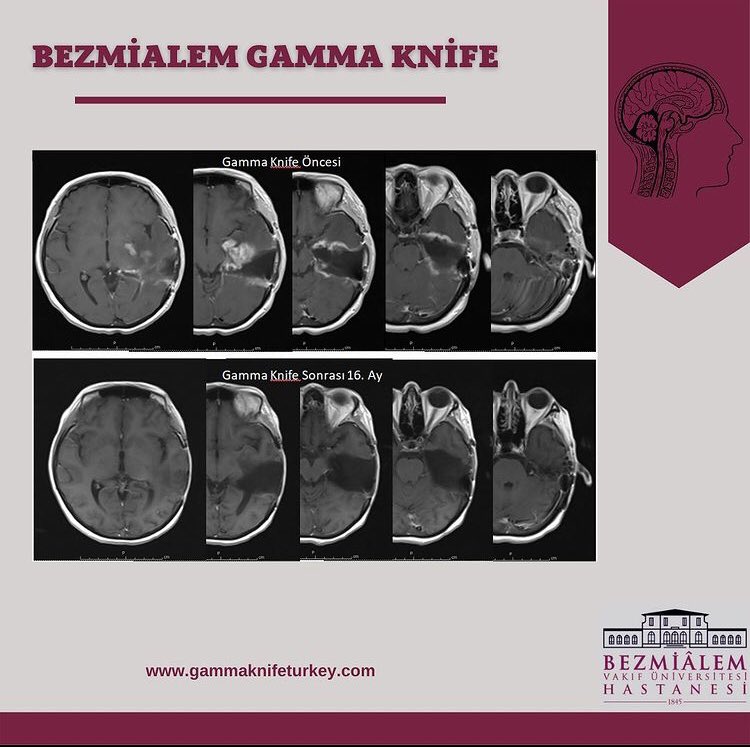 43 yaşında Nüks Glioblastoma tanısıyla Gamma Knife Ünitemize başvuran hastaya 5 fraksiyonda 6 Gy/fr tedavi dozu verilerek tümör başarılı bir şekilde kontrol altına alındı. #beyincerrahisi #gammaknife #glioblastoma