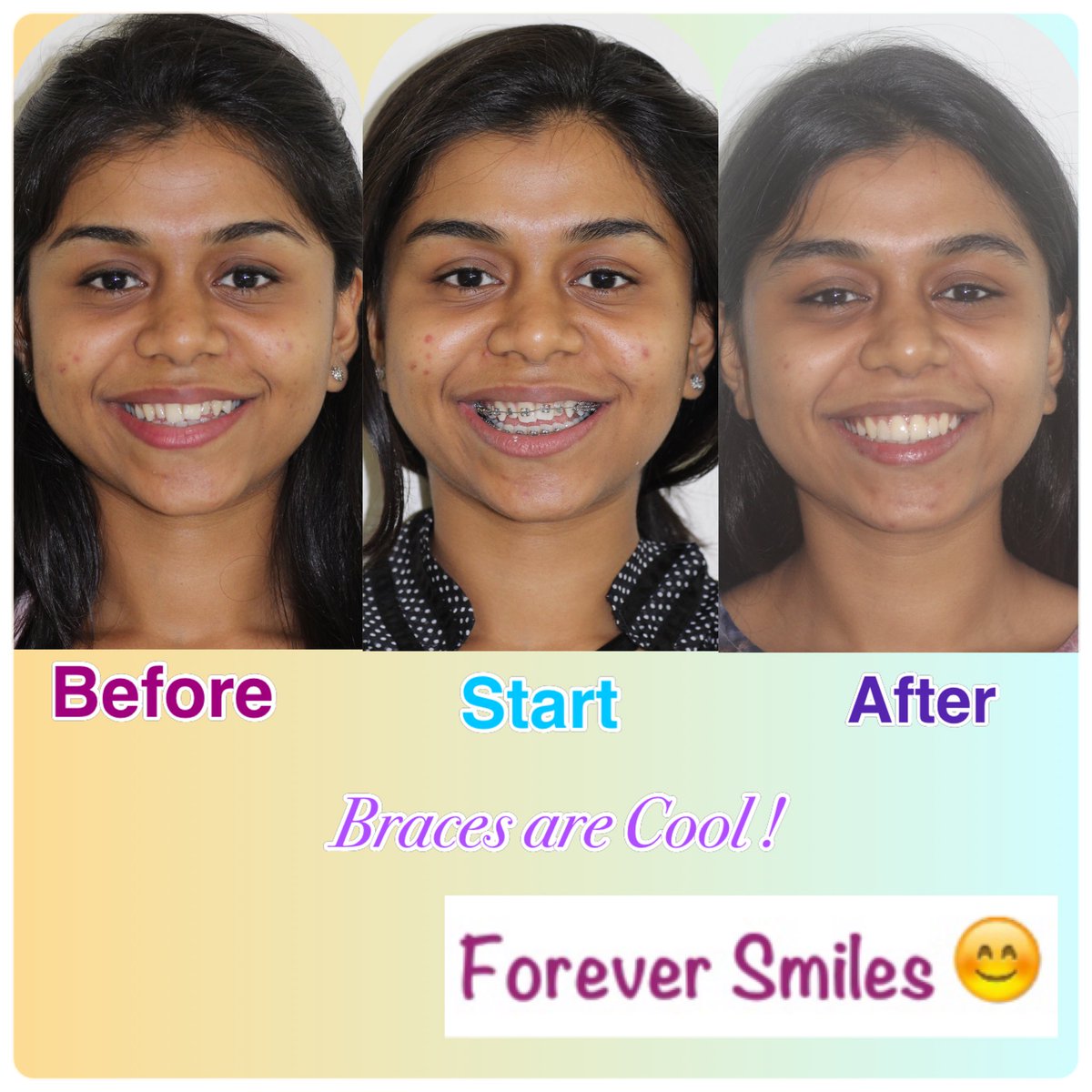 dramitmajethia's tweet photo. We are Happy at Forever Smiles 😊 Dental Clinic to have delivered our patient her Dream Smile as Diwali 🪔 Gift 🎁 @IOSTIMESNEWS @IndianDentalAsn https://t.co/Ab4rGnzMZT