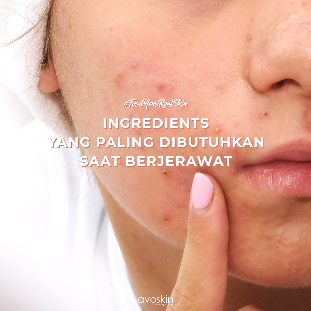 avoskinbeauty's tweet photo. ‼️Rekomendasi Ingredients Untuk Mengurangi Jerawat‼️

Salain AHA atau BHA, ternyata ada berbagai kandungan lain yg bisa mengatasi jerawat kamu loh.  😘

Jangan lupa ❤️&amp;🔁 thread ini ya. #TreatYourRealSkin https://t.co/8AVkhXOHRi