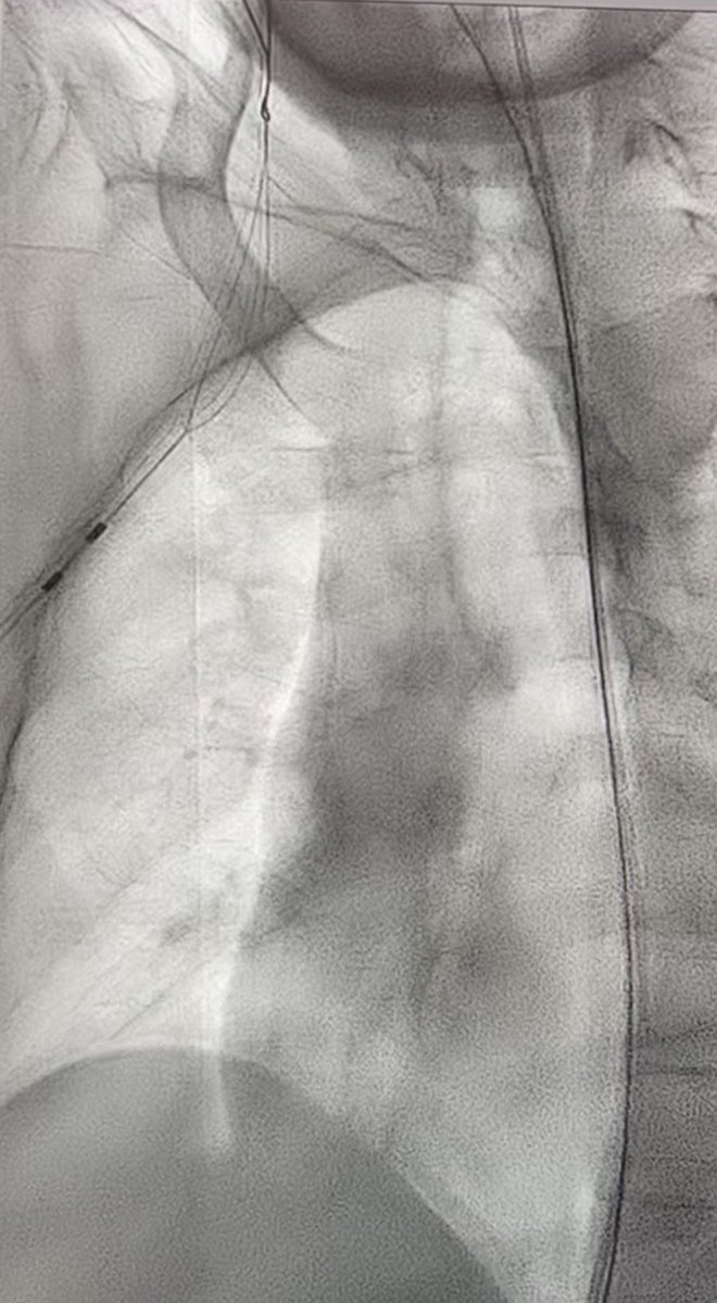 Adeebmsg's tweet photo. IR can do pull type mushroom retained gastrostomy tube insertion.

(( Actions speak louder than words ))

@sirs_ksa @NGHAnews @Arabjir #withoutascaplel  @JVIRmedia @pairsmedia 
@DrMajedAbdulhaq @dr_alqethami @ANGIO_RAD
#irad #sirs #Gastrostomy #prg #peg https://t.co/6r20ElaI1q