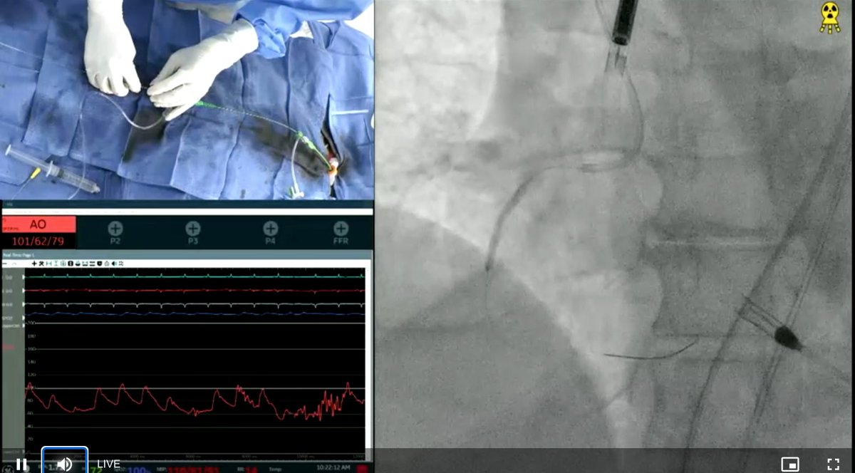 Umair2017's tweet photo. 👉Tune in for a great live case of multivessel PCI with Impella CP

👉Great discussion by the panelists, use of viability, RHC use with MCS

#TCT2021 @Abiomed @TCTMD @TCTConference @crfheart #PROTECT4 https://t.co/EBp6cUg4DW