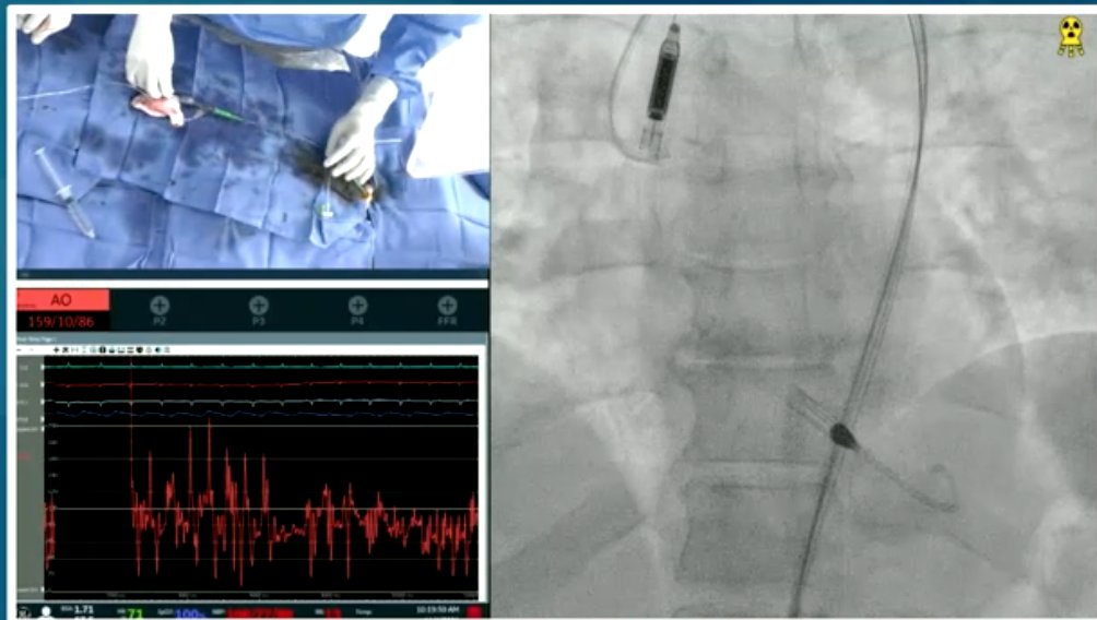 Umair2017's tweet photo. 👉Tune in for a great live case of multivessel PCI with Impella CP

👉Great discussion by the panelists, use of viability, RHC use with MCS

#TCT2021 @Abiomed @TCTMD @TCTConference @crfheart #PROTECT4 https://t.co/EBp6cUg4DW