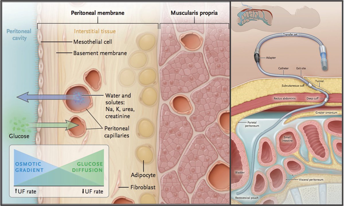 We are thrilled and so proud to highlight the outstanding <a href="/NEJM/">NEJM</a> review on #peritonealdialysis by our very own Dr. Isaac Teitelbaum, Professor of Medicine at <a href="/CU_Kidney/">University of Colorado Nephrology</a> #PD #NephTwitter #MedEd #MedStudentTwitter 

nejm.org/doi/full/10.10…

Congratulations and well done!