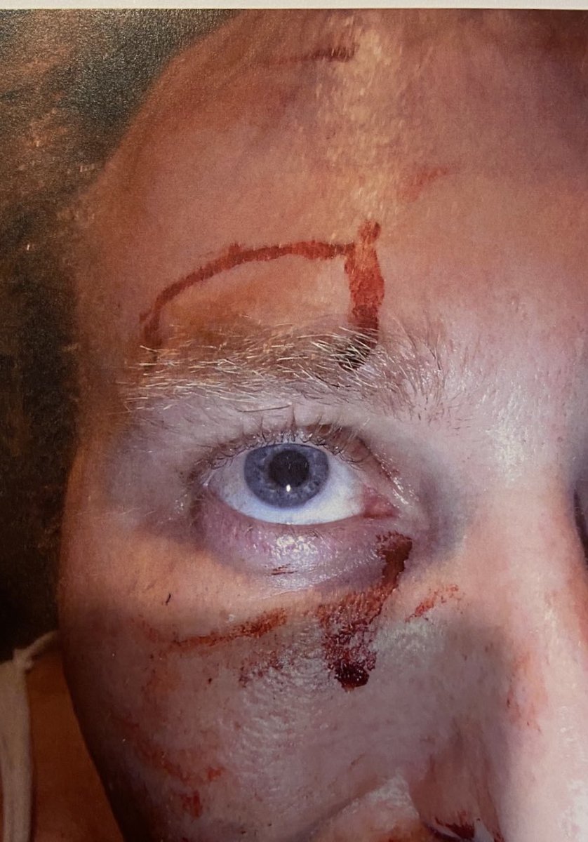 therealbryanwi1's tweet photo. @friendlyjordies Where were the Fixated persons unit when I was bashed to a pulp? And Kristo utters a simple honest question to Barilaro a pack of thugs pinned him to the ground, his mother is assaulted and their pet dog nearly gets killed? https://t.co/Q6eQlSmkIk