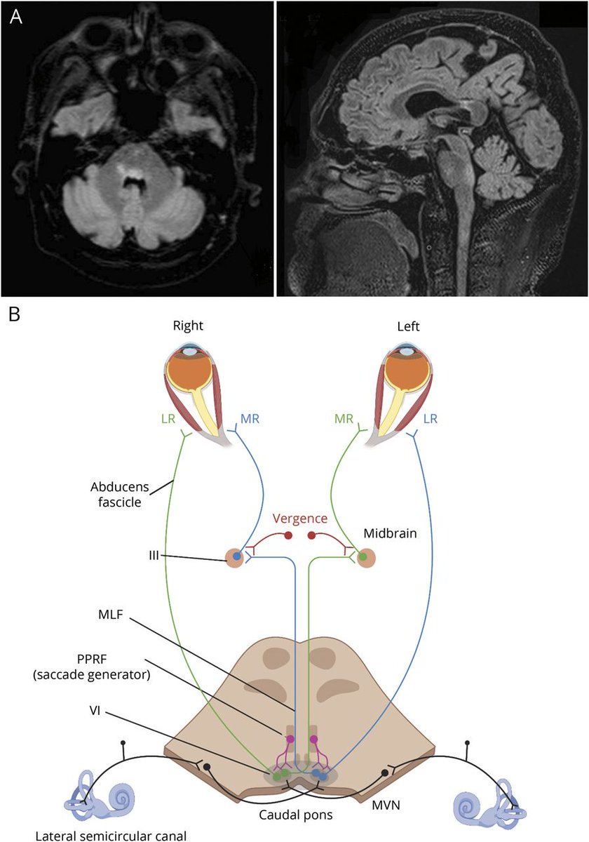 GreenJournal's tweet photo. Teaching Video NeuroImage: Bilateral Horizontal Gaze Palsies With Vertical Ocular Dysmetria From a Demyelinating Lesion of the Pontine Tegmentum https://t.co/HIrtLdnpEN #NeurologyRF https://t.co/Q6Q1AqWcgA